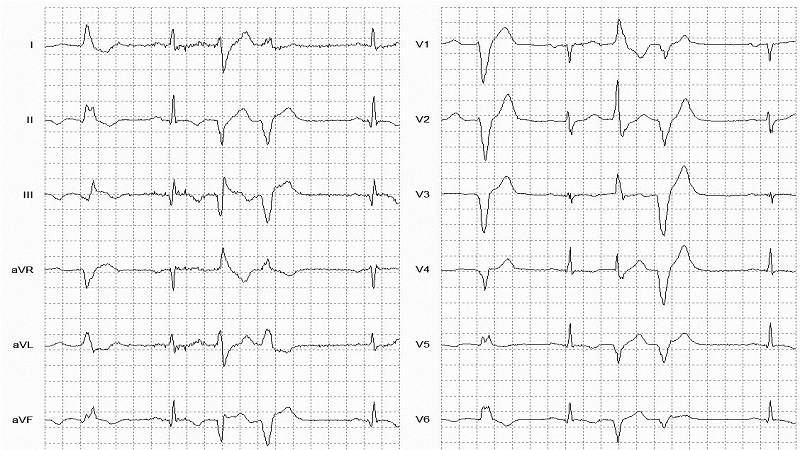 VEB Couplets 12 Lead EKG
